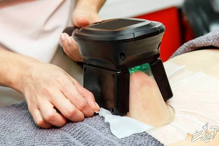 کول اسکالپتینگ